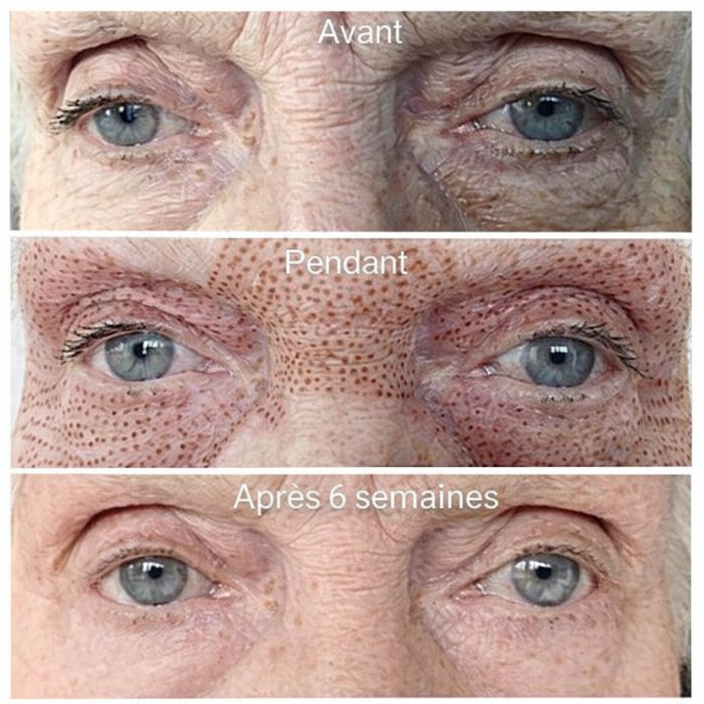 Lifting paupières supérieures et inférieures avant pendant et après 6 semaines Plasma Pen — alternative blépharoplastie Marignane