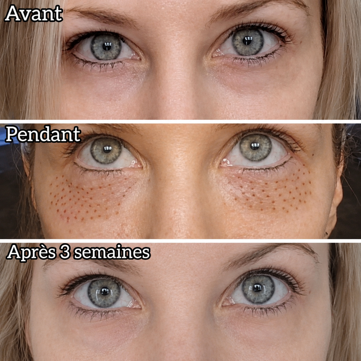 Poches sous les yeux et rides paupières inférieures avant pendant et après 3 semaines Plasma Pen Marignane