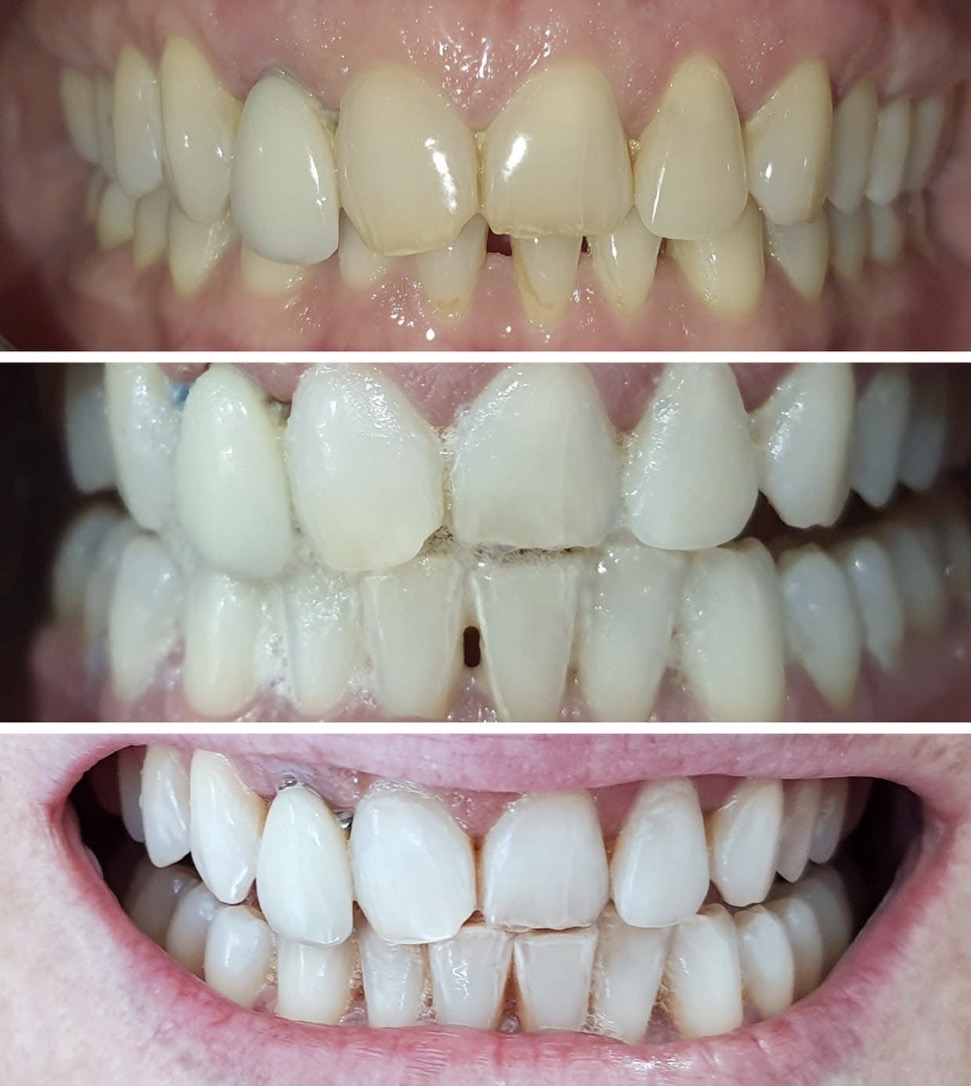 ✨ Le blanchiment dentaire américain : la solution pour un sourire éclatant