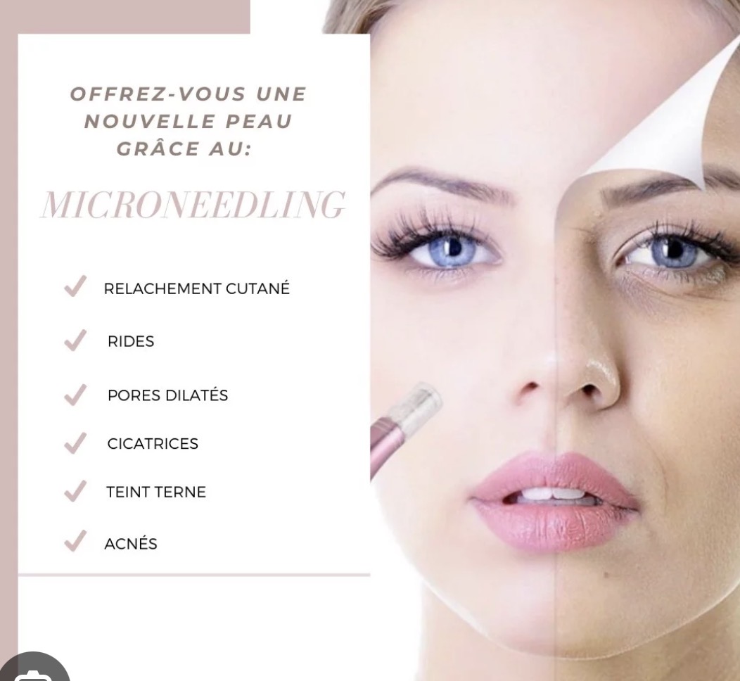 Microneedling à Marignane : le soin idéal pour une peau parfaite | Glowup Gautier