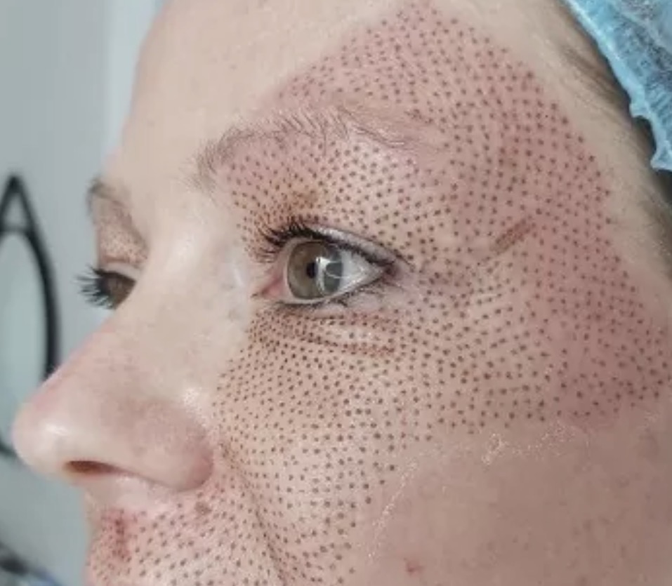 Plasma Pen à Marignane (13) : lifting sans chirurgie | Glow Up Gautier